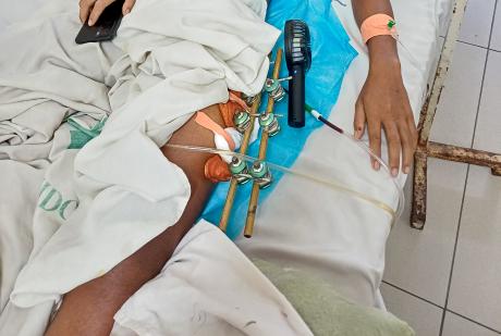 Close-up of Vincencio's leg receiving for a serious injury in Dili Hospital